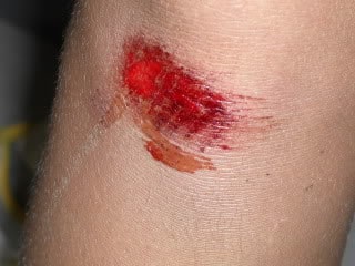 skinned knee