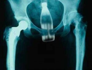 The bottle is kept in the man's intestines, A Fuck Image.